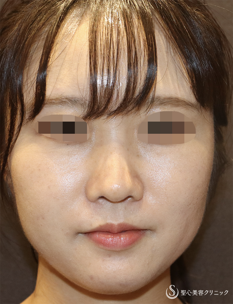 【20代女性・鼻先をスッキリ】ヒアルロン酸注入（鼻）（直後） Before 