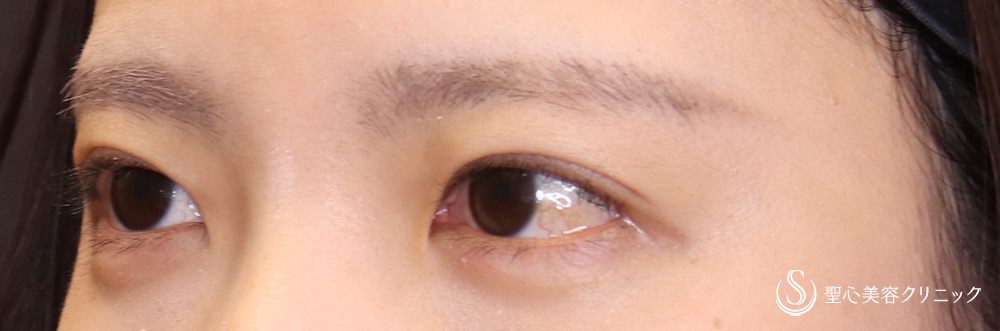 【20代女性・自然な末広二重に】マイクロメソッド+α（二重埋没法）（1ヶ月後） After 