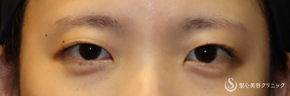 【20代女性・自然な末広二重に】マイクロメソッド+α（二重埋没法）（1ヶ月後） Before 