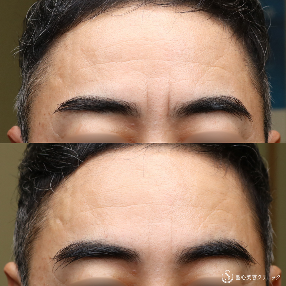 【40代男性・眉間のシワ改善】プレミアムPRP皮膚再生療法（眉間）（2ヶ月後） After 名古屋院・若返り・アンチエイジング・男性