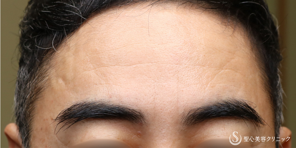 【40代男性・眉間のシワ改善】プレミアムPRP皮膚再生療法（眉間）（2ヶ月後） After 
