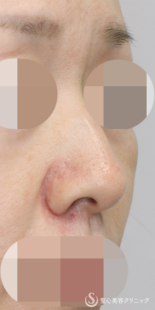 50代女性・ナチュラルな理想の鼻へ】鼻尖縮小＋ 鼻尖形成（耳介