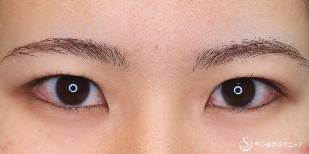 【20代女性・理想の平行二重へ】二重術（切開法）＋目上切開（＋脱脂）（2ヶ月後） Before 