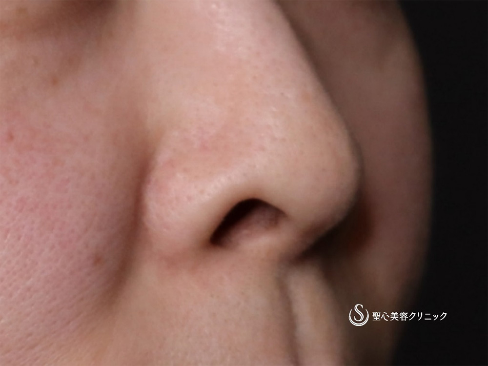 【40代女性・鼻の穴を目立たなく】鼻孔縁下降術（1ヶ月後） Before 