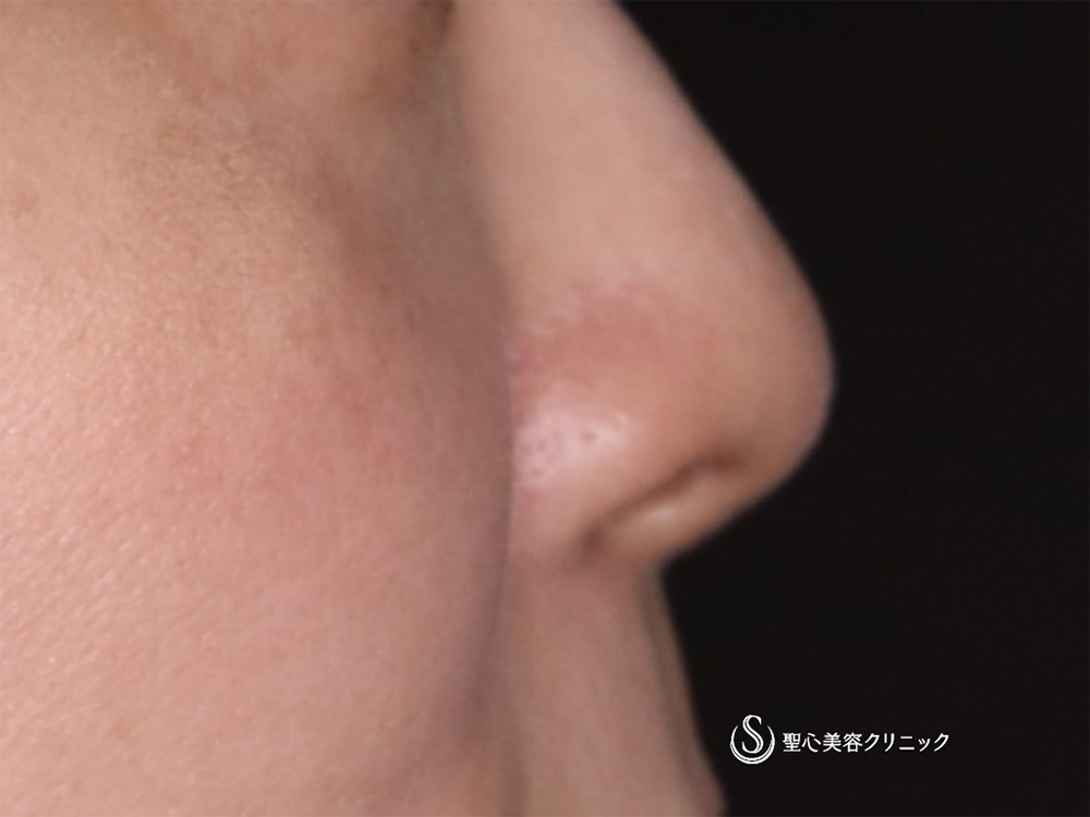 【40代女性・鼻の穴を目立たなく】鼻孔縁下降術（1ヶ月後） After 
