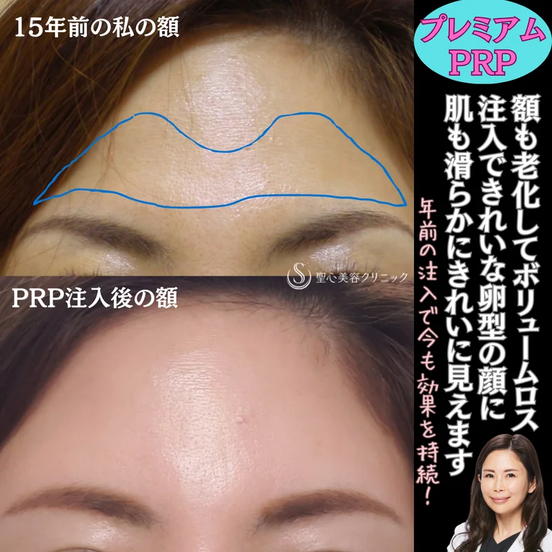 【40代女性・プレミアムPRPで滑らかな額を長期持続】プレミアムPRP皮膚再生療法（15年後） After 