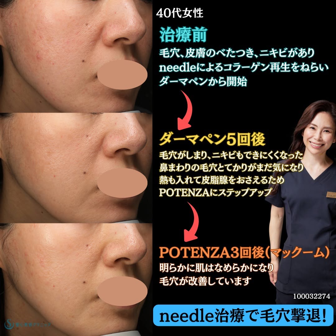 【40代女性・毛穴を閉め、つやのある肌へ】ダーマペン5回＋POTENZA3回（計8回後） After 