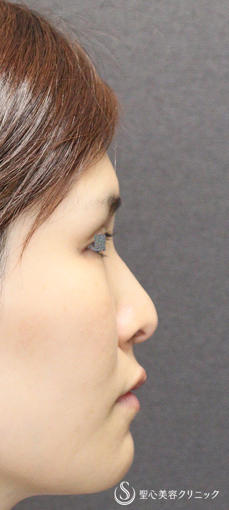 【20代女性・小鼻の丸みを改善】鼻尖縮小（オープン法）＋鼻尖形成（耳介軟骨移植）＋小鼻縮小（内側外側法）（1ヶ月後） Before 