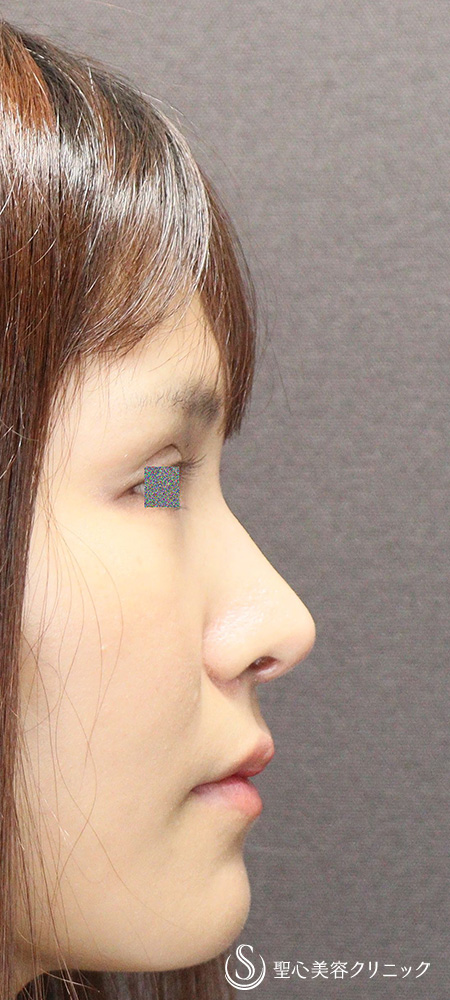 【20代女性・小鼻の丸みを改善】鼻尖縮小（オープン法）＋鼻尖形成（耳介軟骨移植）＋小鼻縮小（内側外側法）（1ヶ月後） After 