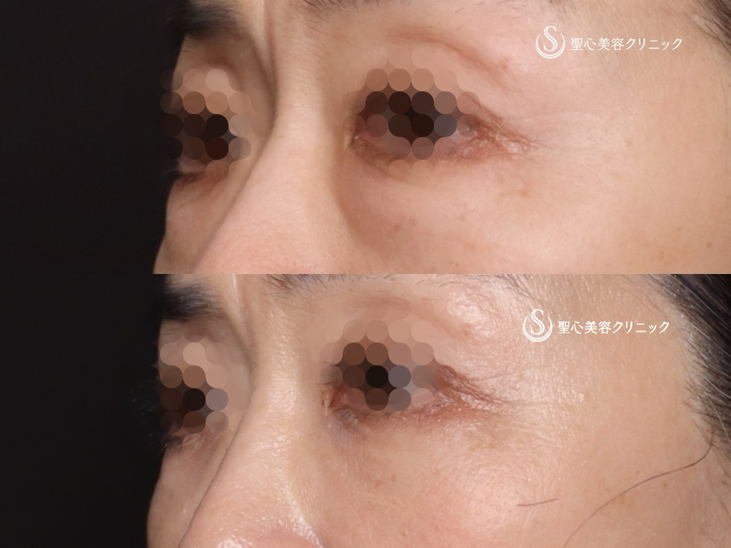 【60代女性・皮膚を切開せずに目の下の脂肪取りとたるみ治療】目の下の脂肪取り（経結膜下脱脂法）＋プレミアムPRP皮膚再生療法（1ヶ月後） After 