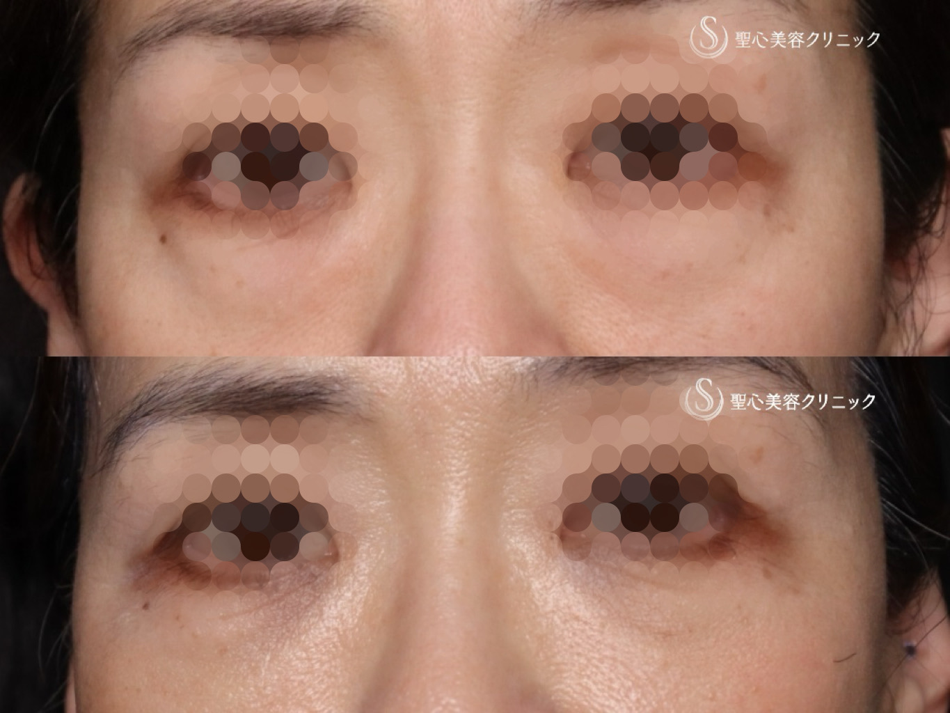 【60代女性・皮膚を切開せずに目の下の脂肪取りとたるみ治療】目の下の脂肪取り（経結膜下脱脂法）＋プレミアムPRP皮膚再生療法（1ヶ月後） After 