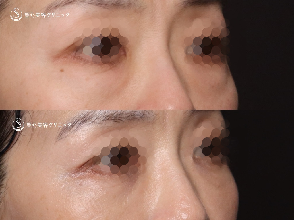 【60代女性・皮膚を切開せずに目の下の脂肪取りとたるみ治療】目の下の脂肪取り（経結膜下脱脂法）＋プレミアムPRP皮膚再生療法（1ヶ月後） After 