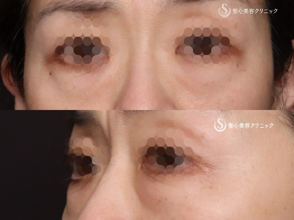 【60代女性・皮膚を切開せずに目の下の脂肪取りとたるみ治療】目の下の脂肪取り（経結膜下脱脂法）＋プレミアムPRP皮膚再生療法（1ヶ月後） Before 