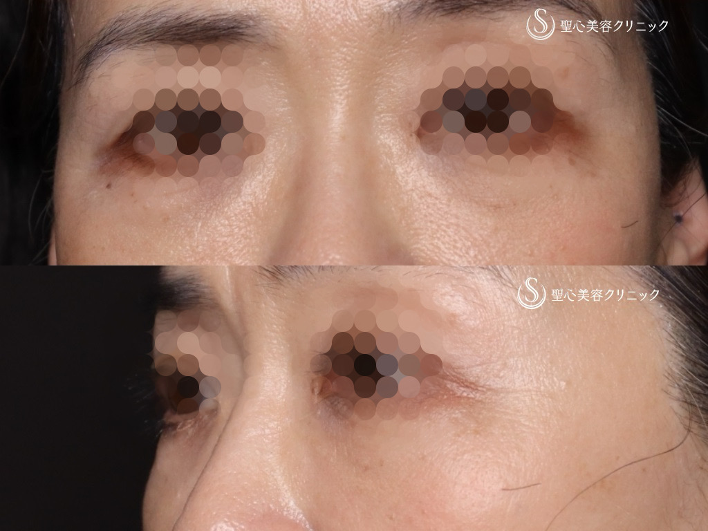 【60代女性・皮膚を切開せずに目の下の脂肪取りとたるみ治療】目の下の脂肪取り（経結膜下脱脂法）＋プレミアムPRP皮膚再生療法（1ヶ月後） After 