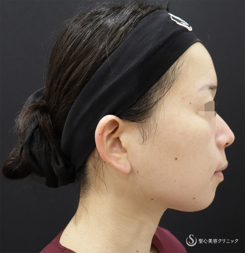【30代女性・顔に立体感】ヒアルロン酸注入（ジュビダームビスタボラックスXC＋ジュビダームビスタボリューマXC）（翌日） Before 
