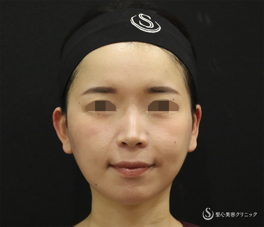 【30代女性・顔に立体感】ヒアルロン酸注入（ジュビダームビスタボラックスXC＋ジュビダームビスタボリューマXC）（翌日） After 