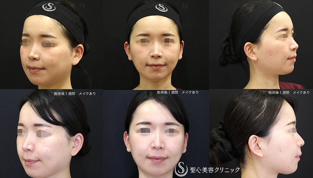【30代女性・顔に立体感】ヒアルロン酸注入（ジュビダームビスタボラックスXC＋ジュビダームビスタボリューマXC）（翌日） After 
