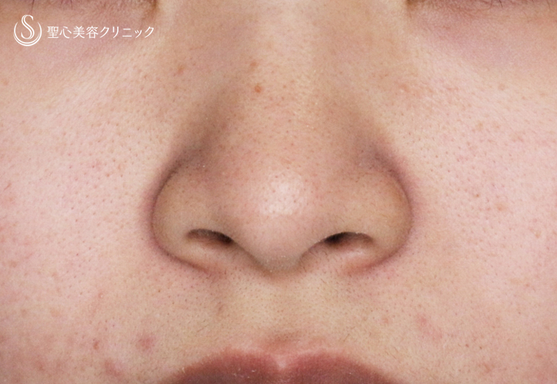 【18歳女性・最小限の切開で「忘れ鼻」】小鼻縮小術+α法「Ver.7.5」（直後〜1年1ヶ月後） Before 