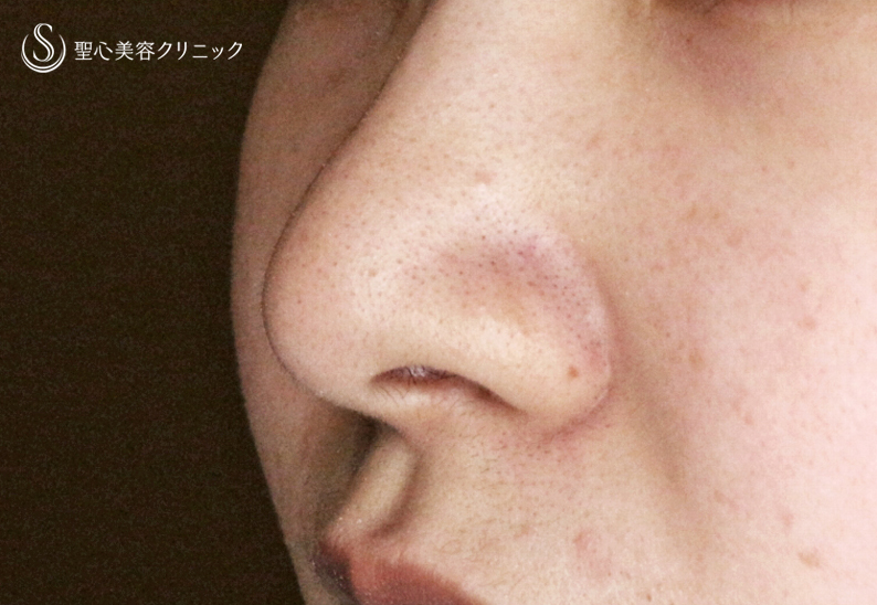 【18歳女性・最小限の切開で「忘れ鼻」】小鼻縮小術+α法「Ver.7.5」（直後〜1年1ヶ月後） Before 