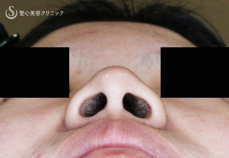 【18歳女性・最小限の切開で「忘れ鼻」】小鼻縮小術+α法「Ver.7.5」（直後〜1年1ヶ月後） Before 