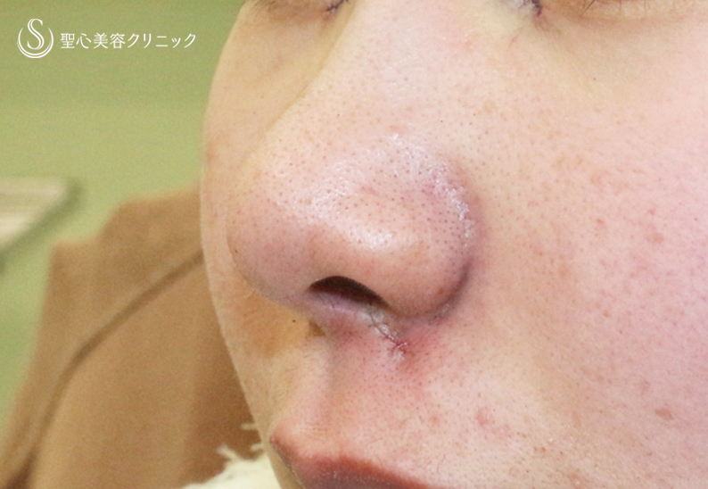 【18歳女性・最小限の切開で「忘れ鼻」】小鼻縮小術+α法「Ver.7.5」（直後〜1年1ヶ月後） Before 