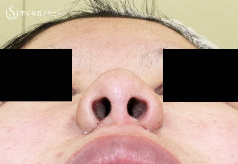【18歳女性・最小限の切開で「忘れ鼻」】小鼻縮小術+α法「Ver.7.5」（直後〜1年1ヶ月後） Before 