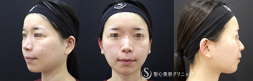 【30代女性・顔に立体感】ヒアルロン酸注入（ジュビダームビスタボラックスXC＋ジュビダームビスタボリューマXC）（翌日） After 