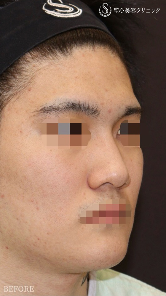 【20代男性・鼻フル後1週間で美男子鼻に】鼻中隔延長（耳介軟骨移植）＋鼻尖形成（耳介軟骨移植）＋鼻背軟骨移植（耳介軟骨移植）（1週間後） Before 