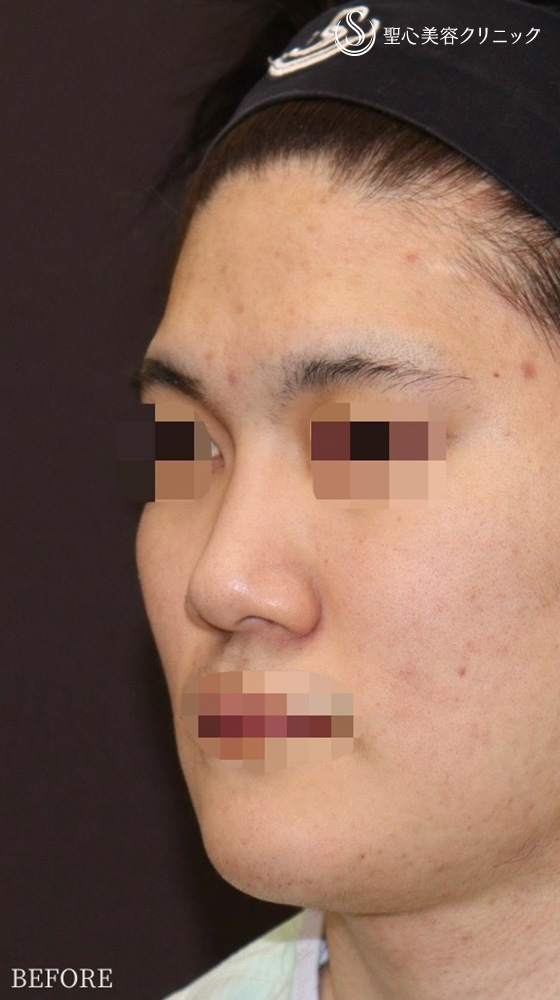 【20代男性・鼻フル後1週間で美男子鼻に】鼻中隔延長（耳介軟骨移植）＋鼻尖形成（耳介軟骨移植）＋鼻背軟骨移植（耳介軟骨移植）（1週間後） Before 