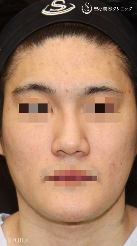 【20代男性・鼻フル後1週間で美男子鼻に】鼻中隔延長（耳介軟骨移植）＋鼻尖形成（耳介軟骨移植）＋鼻背軟骨移植（耳介軟骨移植）（1週間後） Before 