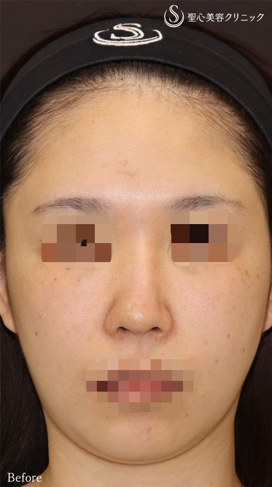 【30代女性・鼻の曲がり、ACR、鼻の高さを改善し美鼻に】鼻中隔延長（耳介軟骨移植）＋鼻尖形成（耳介軟骨移植）＋オーダーメイドプロテーゼ＋他院修正（6ヶ月後） Before 