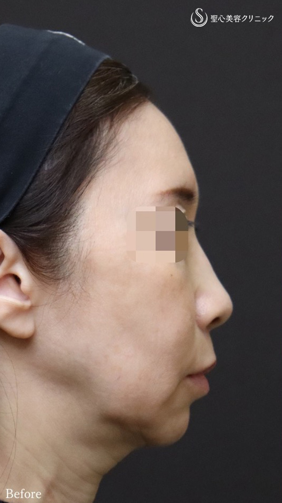 【50代女性・フェイスリフト効果を最大限に、持続力も最大限に】フェイスリフト＋顎下、頬の脂肪吸引＋リガメント処置（1ヶ月後） Before 