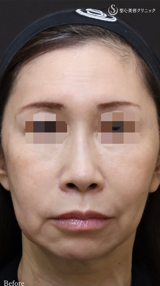 【50代女性・フェイスリフト効果を最大限に、持続力も最大限に】フェイスリフト＋顎下、頬の脂肪吸引＋リガメント処置（1ヶ月後） Before 
