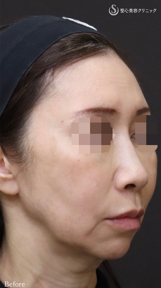 【50代女性・フェイスリフト効果を最大限に、持続力も最大限に】フェイスリフト＋顎下、頬の脂肪吸引＋リガメント処置（1ヶ月後） Before 
