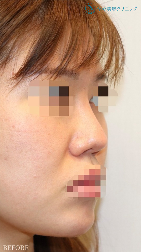 【30代女性・直線化した鼻柱を自然なカーブに】鼻中隔延長（耳介軟骨移植）＋鼻尖形成（耳介軟骨移植）＋プロテーゼ入替＋他院修正（3年後） Before 