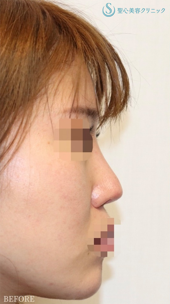 【30代女性・直線化した鼻柱を自然なカーブに】鼻中隔延長（耳介軟骨移植）＋鼻尖形成（耳介軟骨移植）＋プロテーゼ入替＋他院修正（3年後） Before 