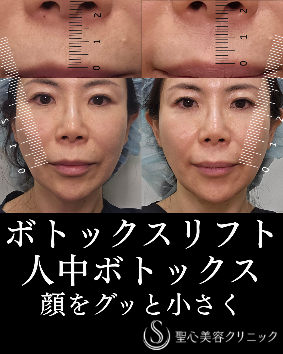 【51歳女性・小顔に】ボトックスリフト＋ボトックス注入（1週間後） After 