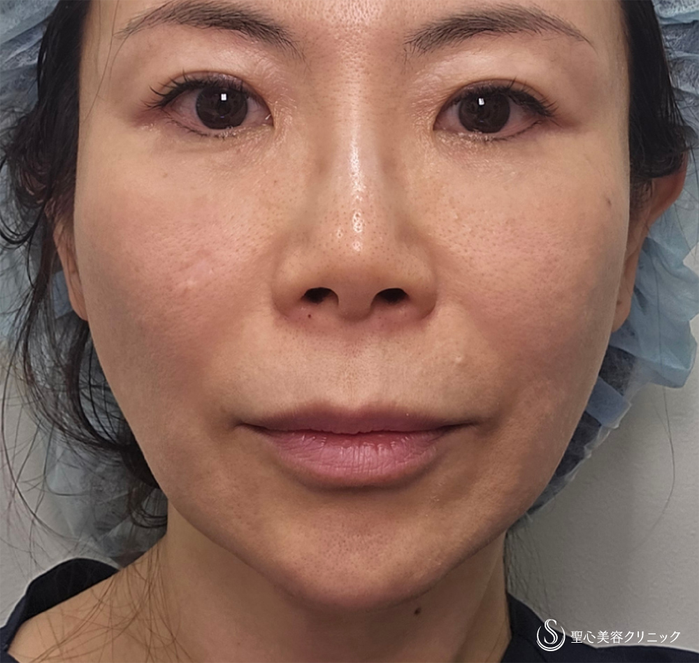 【51歳女性・小顔に】ボトックスリフト＋ボトックス注入（1週間後） Before 