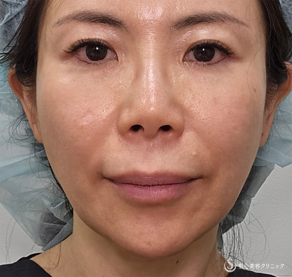 【51歳女性・小顔に】ボトックスリフト＋ボトックス注入（1週間後） After 