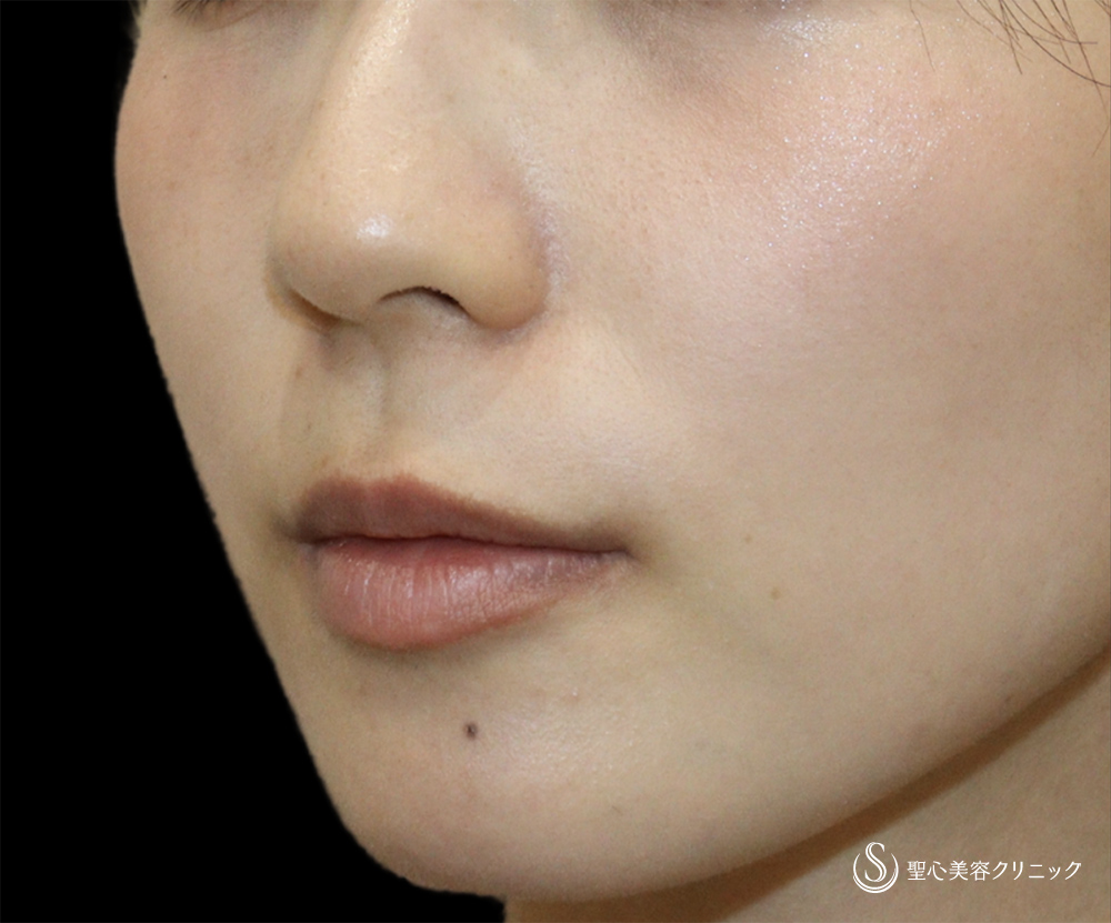 【20代女性・唇の自然なボリュームアップ】ヒアルロン酸注入（唇）（直後） Before 