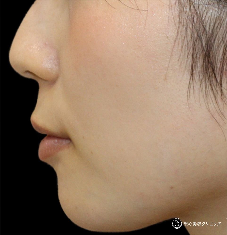 【20代女性・唇の自然なボリュームアップ】ヒアルロン酸注入（唇）（直後） Before 