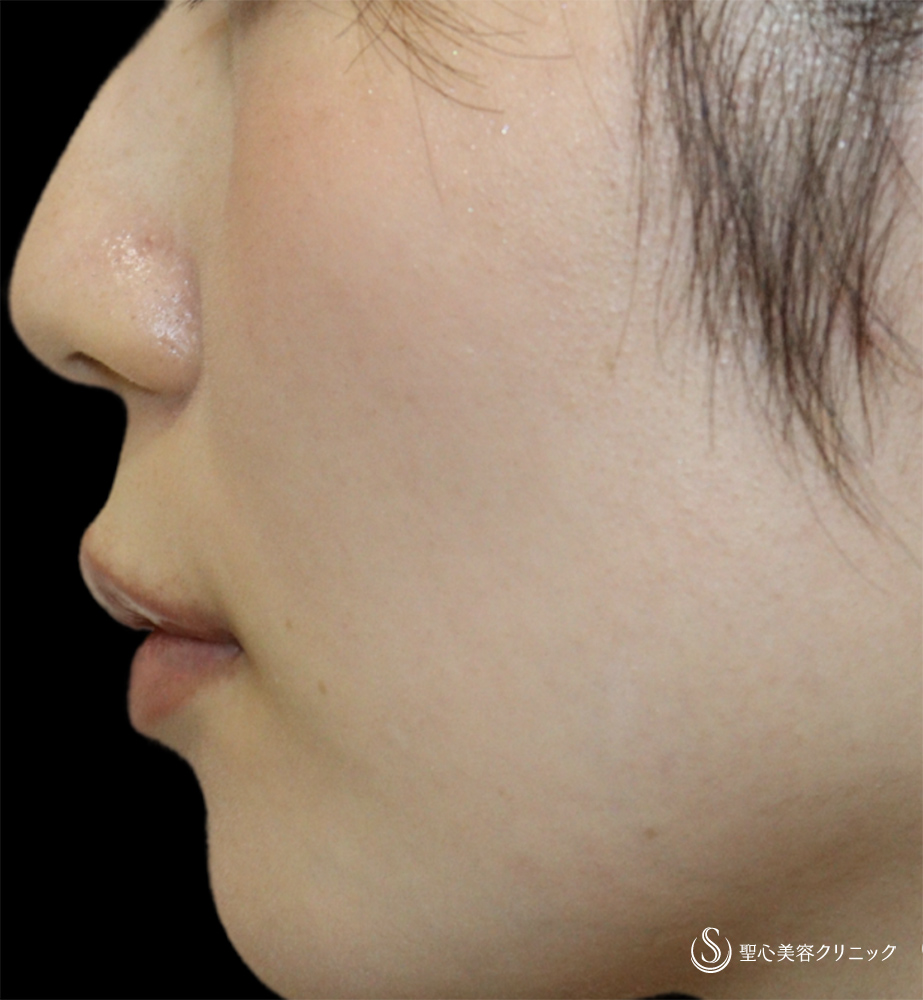【20代女性・唇の自然なボリュームアップ】ヒアルロン酸注入（唇）（直後） After 