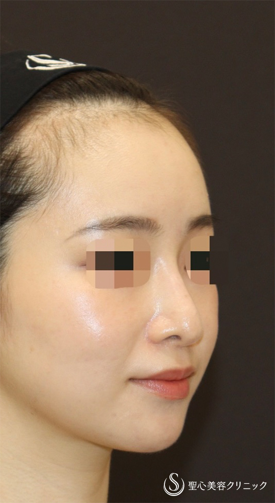 【20代女性・ドロップした鼻先を高くして美鼻に】他院修正＋鼻尖縮小＋鼻尖形成（耳介軟骨）＋ストラット法（耳介軟骨）（1年後） Before 