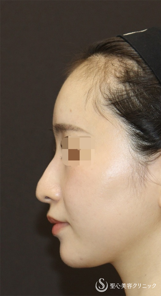 【20代女性・ドロップした鼻先を高くして美鼻に】他院修正＋鼻尖縮小＋鼻尖形成（耳介軟骨）＋ストラット法（耳介軟骨）（1年後） Before 
