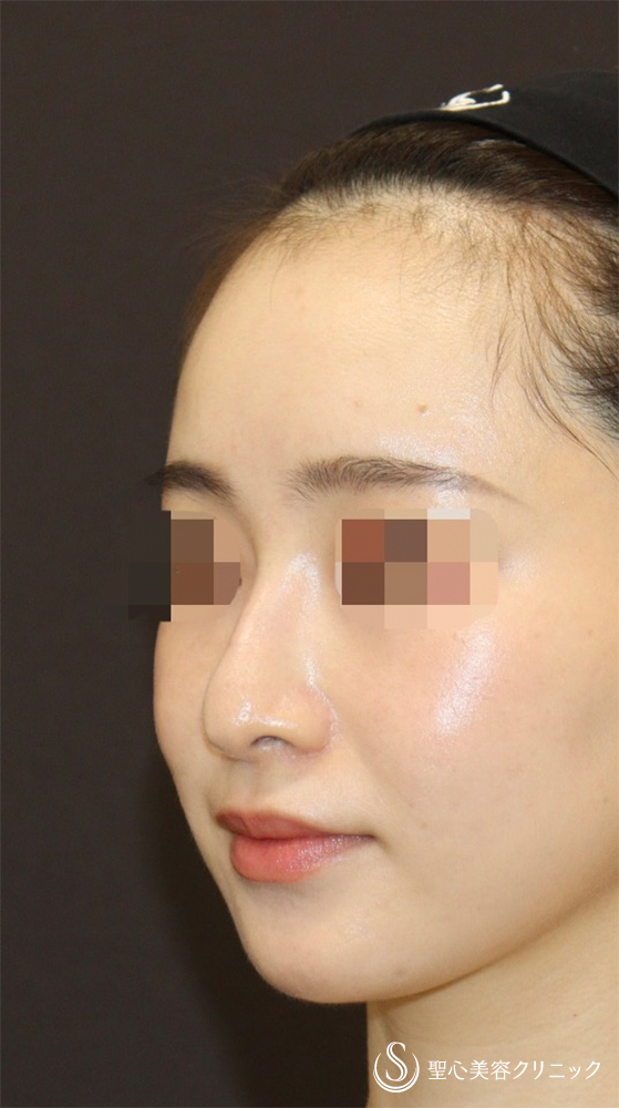 【20代女性・ドロップした鼻先を高くして美鼻に】他院修正＋鼻尖縮小＋鼻尖形成（耳介軟骨）＋ストラット法（耳介軟骨）（1年後） Before 