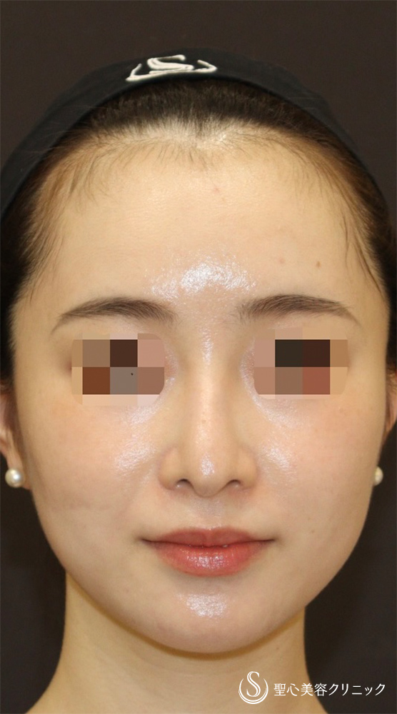 【20代女性・ドロップした鼻先を高くして美鼻に】他院修正＋鼻尖縮小＋鼻尖形成（耳介軟骨）＋ストラット法（耳介軟骨）（1年後） Before 