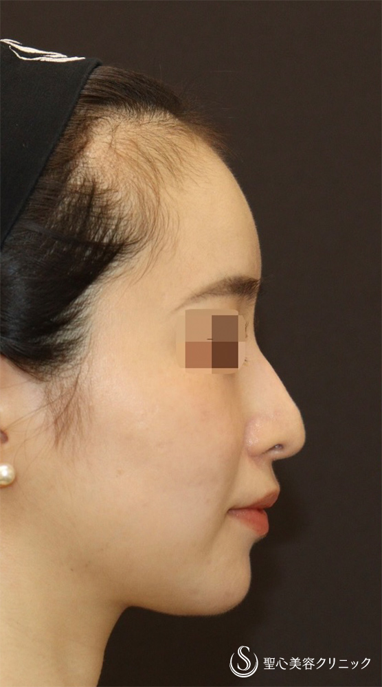 【20代女性・ドロップした鼻先を高くして美鼻に】他院修正＋鼻尖縮小＋鼻尖形成（耳介軟骨）＋ストラット法（耳介軟骨）（1年後） Before 