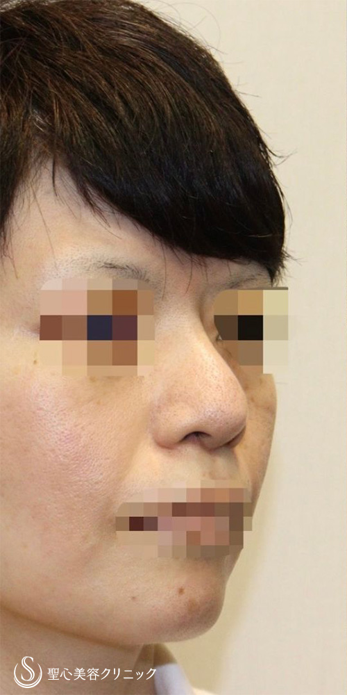 【40代女性・皮膚が厚く硬い方も綺麗にスッキリと】鼻中隔延長術（肋軟骨）＋鼻尖形成（耳介軟骨移植）＋プロテーゼ入替（2年後） Before 