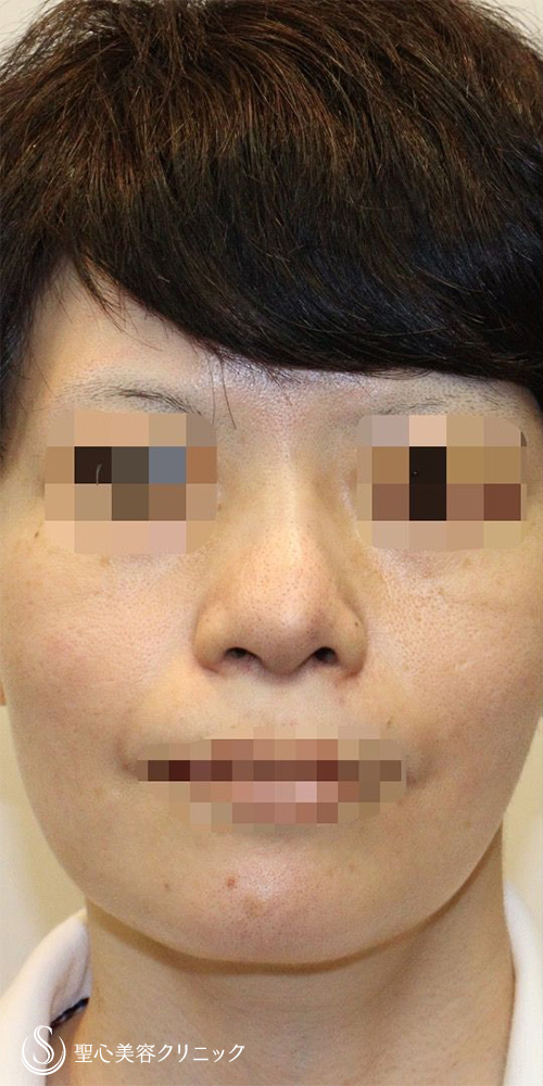 【40代女性・皮膚が厚く硬い方も綺麗にスッキリと】鼻中隔延長術（肋軟骨）＋鼻尖形成（耳介軟骨移植）＋プロテーゼ入替（2年後） Before 