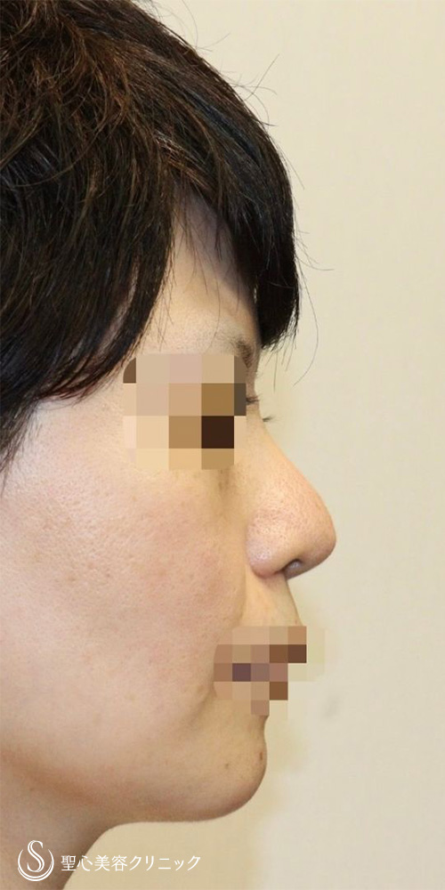 【40代女性・皮膚が厚く硬い方も綺麗にスッキリと】鼻中隔延長術（肋軟骨）＋鼻尖形成（耳介軟骨移植）＋プロテーゼ入替（2年後） Before 
